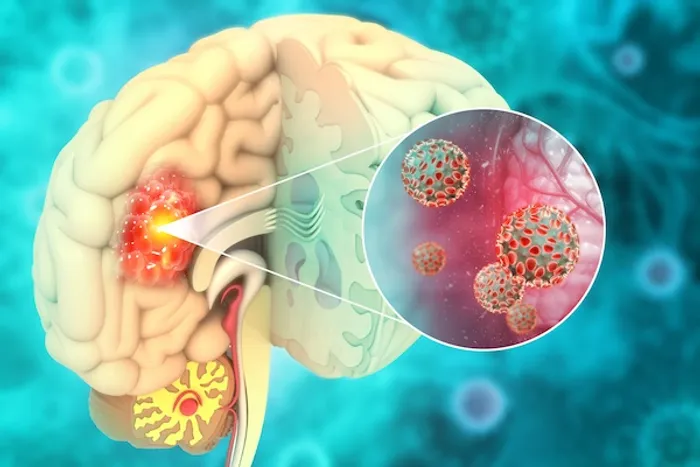 brain tumours